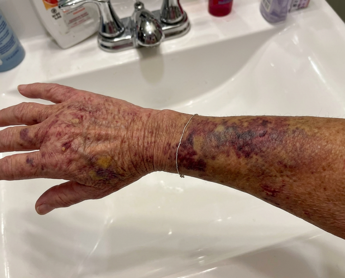 Severe bruising on elderly hand and wrist